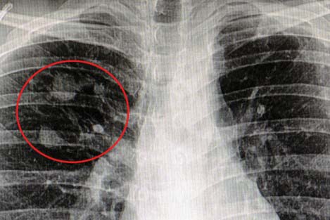 MRI of lung cancer nodules