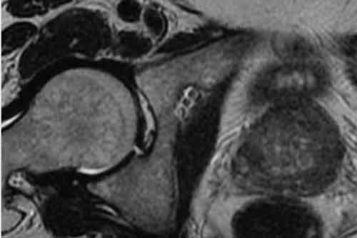 An MRI Showing Prostate Cancer